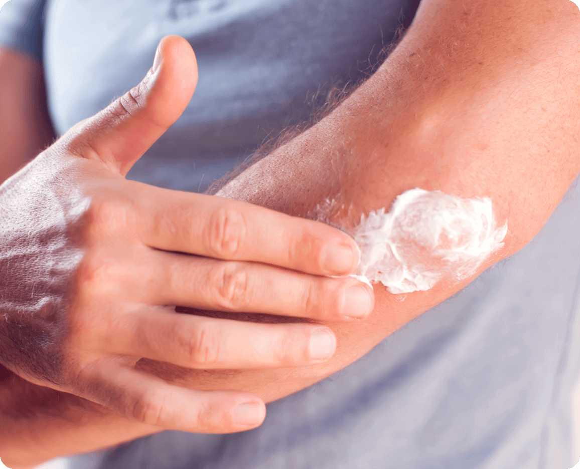 Person applying moisturiser to the skin