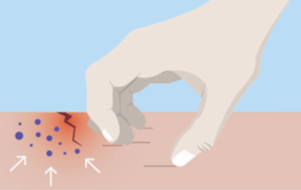 illustration showing hand scratching the skin