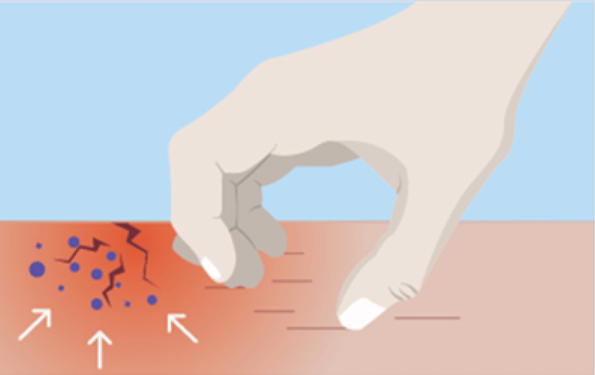 illustration showing skin barrier breaking down and redness of skin