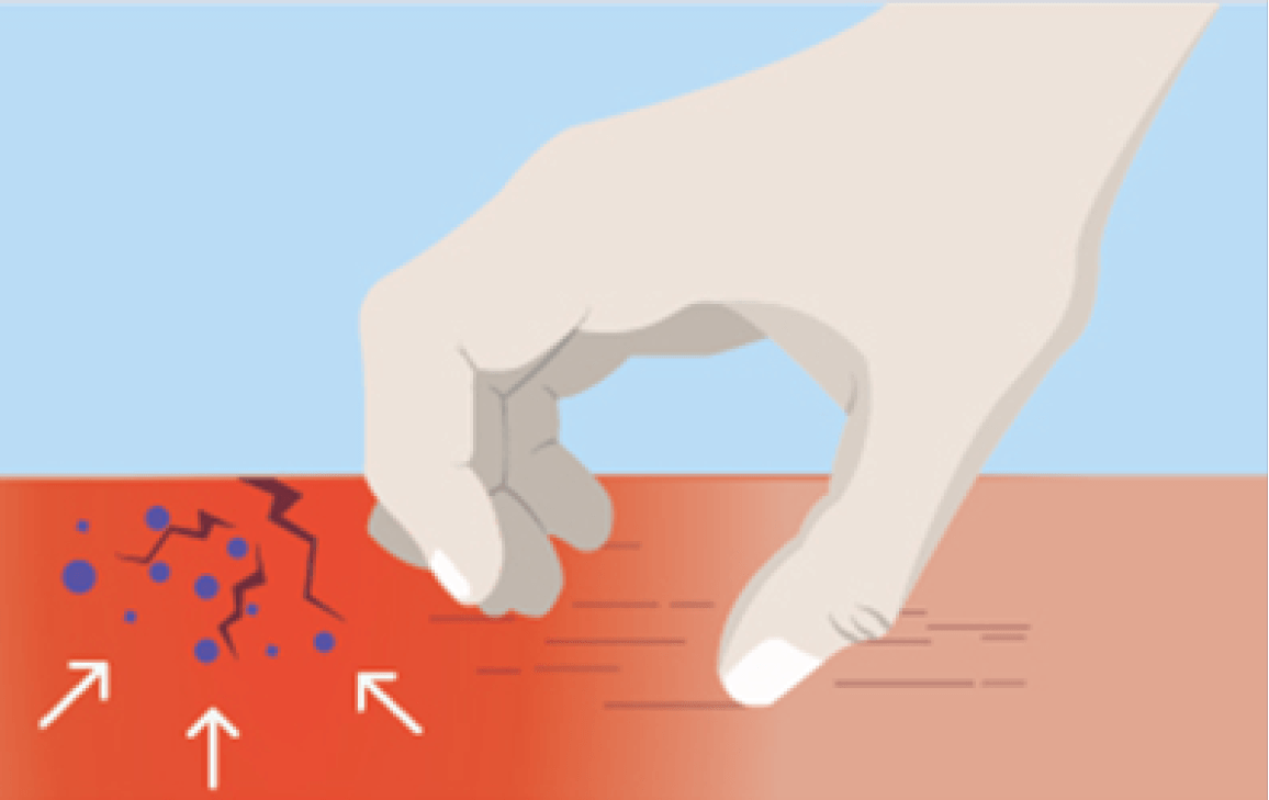 illustration showing damaged skin and redness